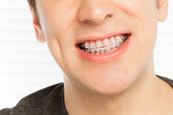 Person smiling while wearing metal braces, showing brackets and wires during the early phase of orthodontic treatment