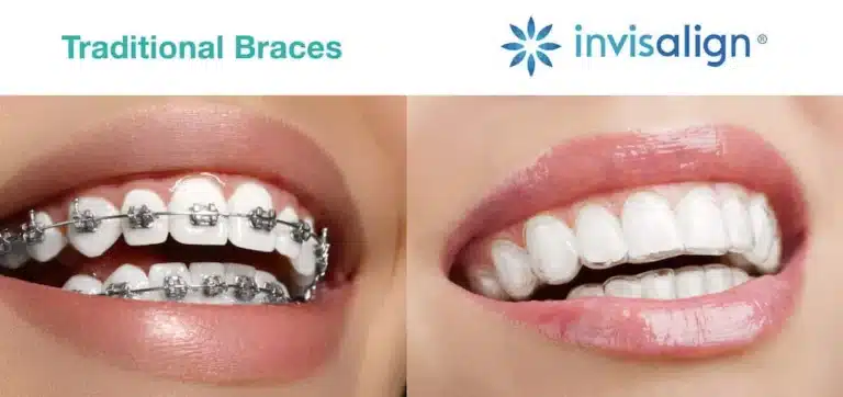 Side-by-side comparison showing traditional metal braces and clear aligner treatment on teeth