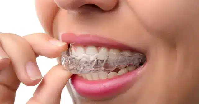 Person placing a clear aligner over their teeth during orthodontic treatment