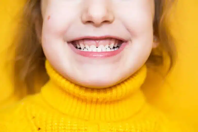 Child teeth showing early bite misalignment and possible crossbite development