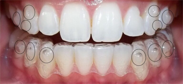 Clear orthodontic aligners placed on teeth as part of treatment before jaw surgery
