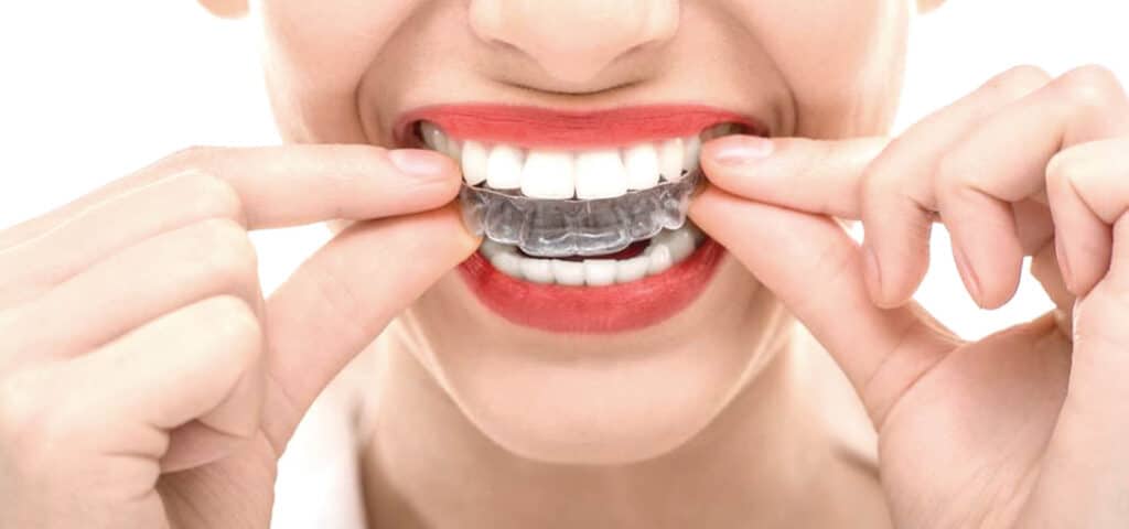 Close-up of a person using both hands to place a transparent clear aligner tray over their upper teeth while smiling