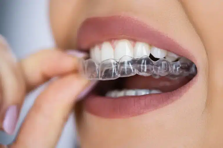 Close-up of a person placing a clear aligner tray over their upper teeth during orthodontic treatment.